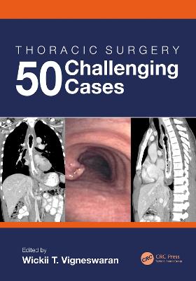 Thoracic Surgery: 50 Challenging cases: 50 Challenging Cases